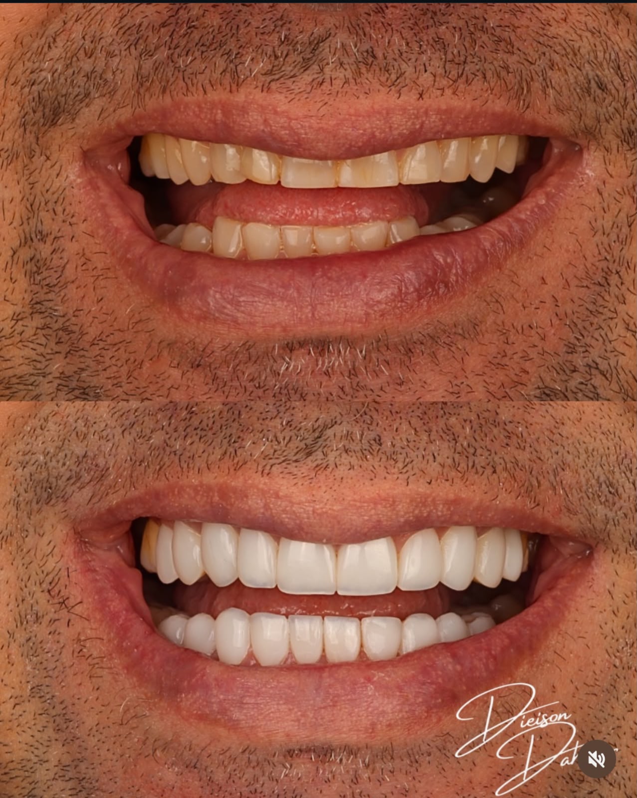 Resultado de facetas em close do sorriso