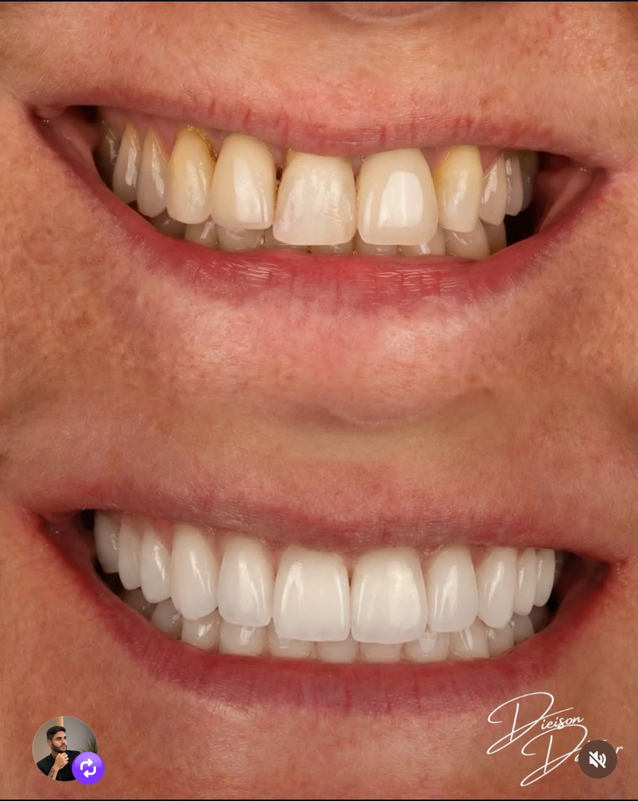 Resultado de reabilitação estética do sorriso, vista frontal