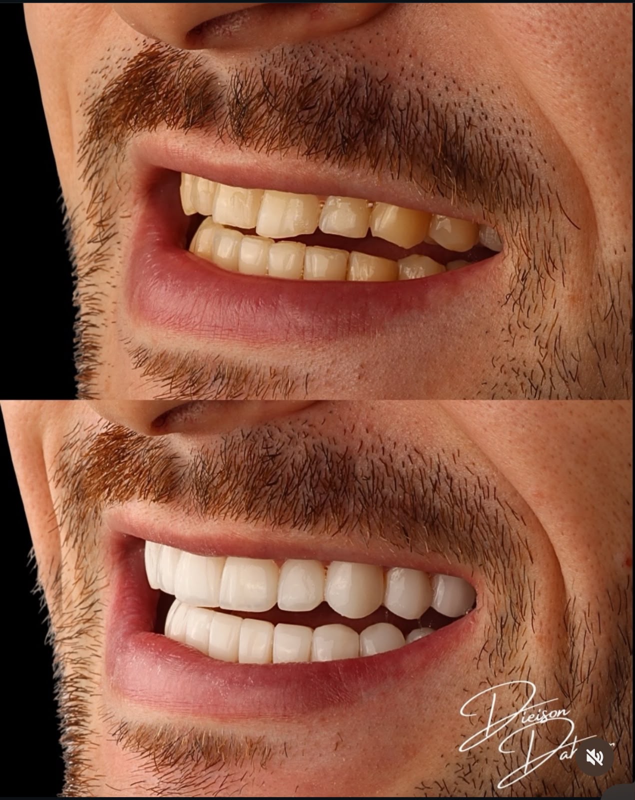 Resultado de facetas em porcelana em vista lateral do sorriso