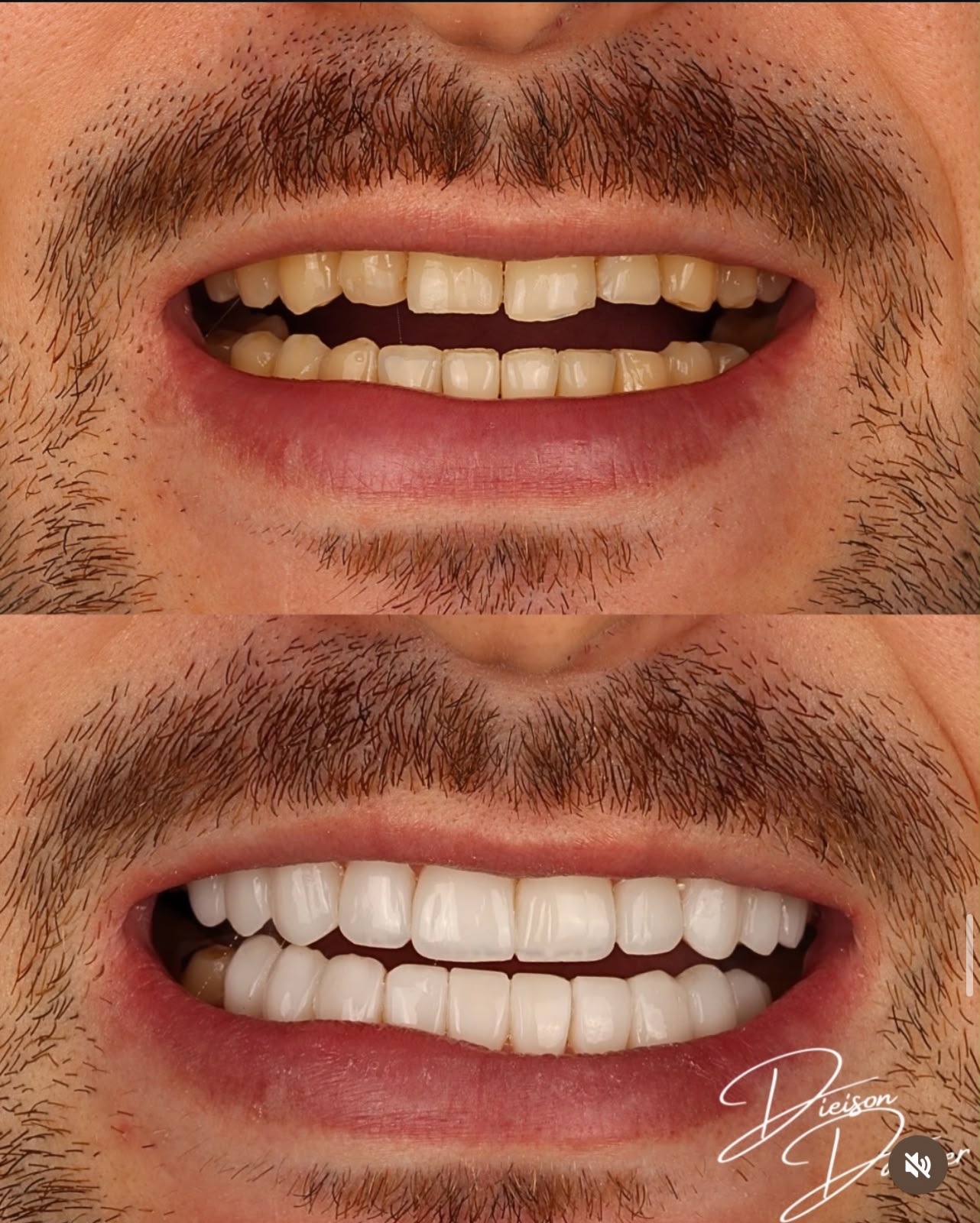 Resultado de facetas em resina no sorriso de um paciente
